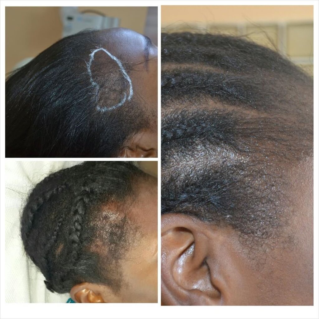 Successful Mesotherapy treatment for hair loss at laserderm clinics, Nigeria