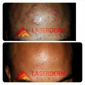 Acne Treatment Laserderm Clinics
