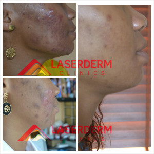Acne Treatment Laserderm Clinics