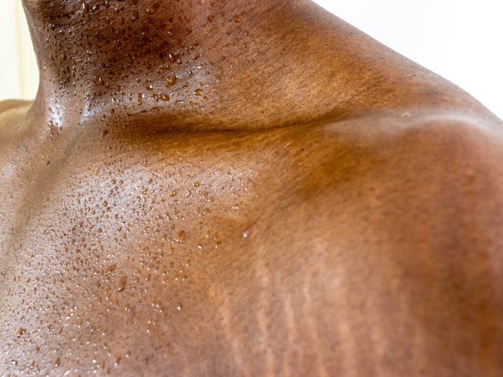 Facts about Stretch Marks Everyone Should Know