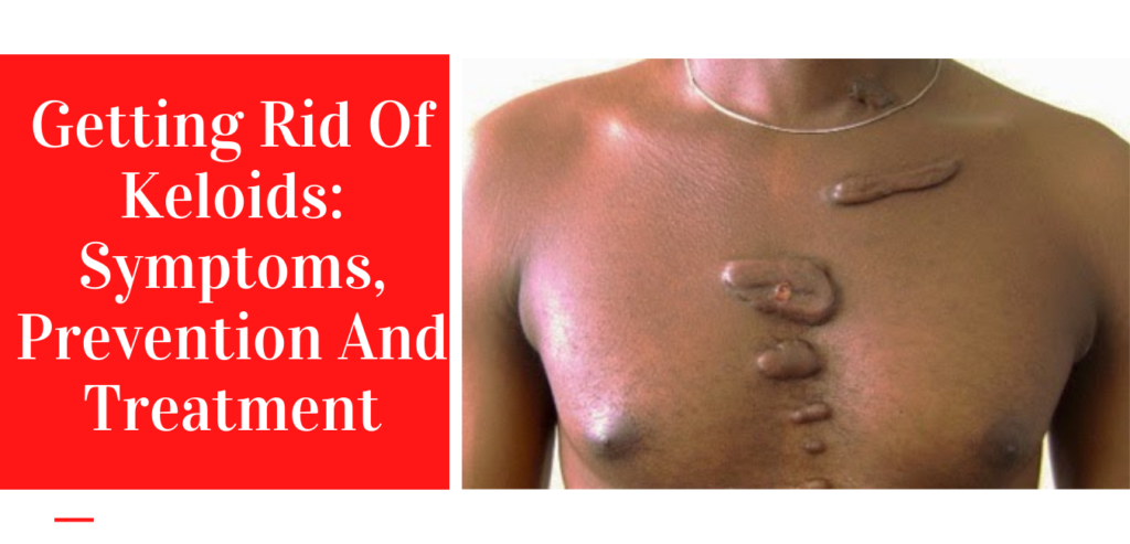 Getting Rid Of Keloids: Symptoms, Prevention And Treatment
